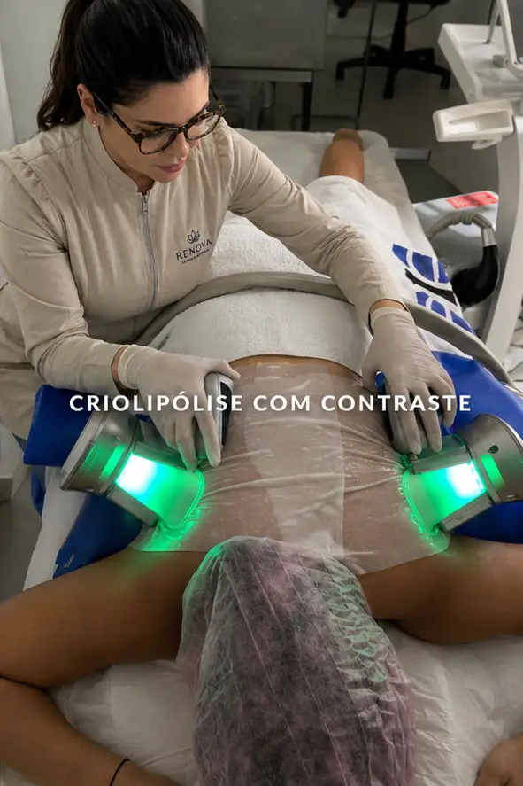 Criolipólise com contraste térmico sendo aplicada no abdômen em Sorocaba