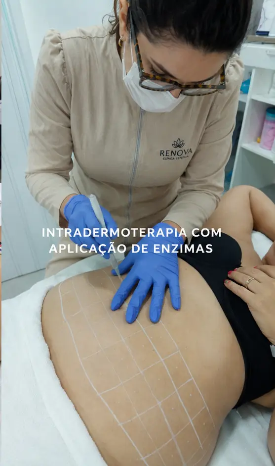 Intradermoterapia com aplicação de enzimas no corpo em Sorocaba