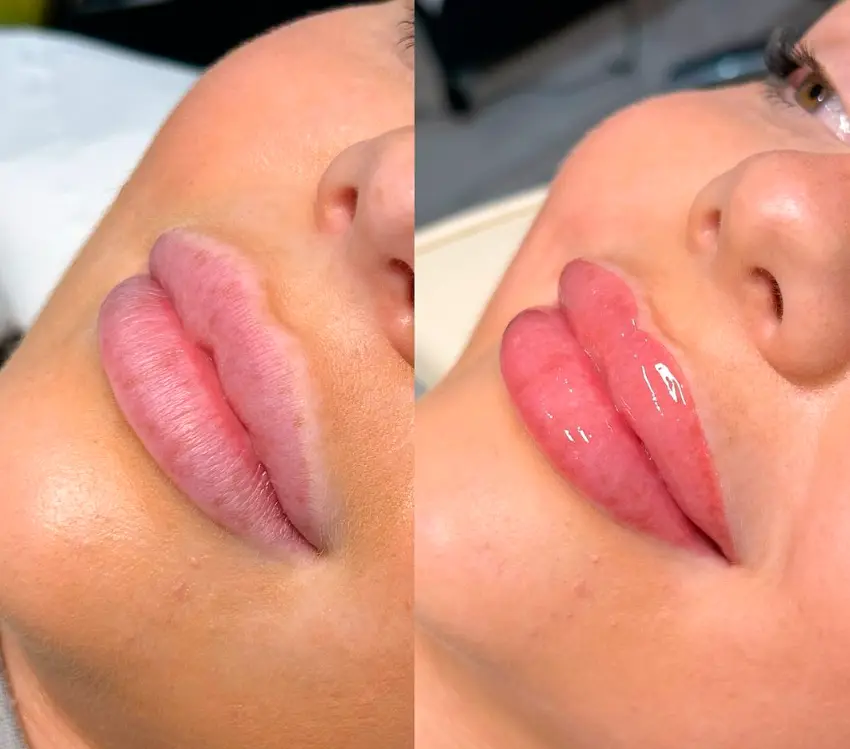 Antes e depois de harmonização labial na Renova Clínica Estética em Sorocaba