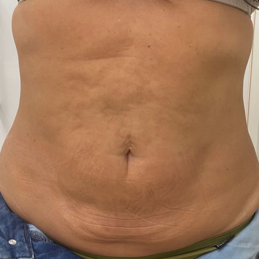 Abdômen antes do tratamento de redução de medidas na Renova Clínica Estética em Sorocaba